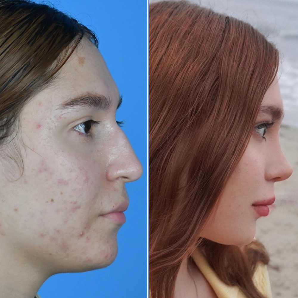 Before and after rhinoplasty result 2
