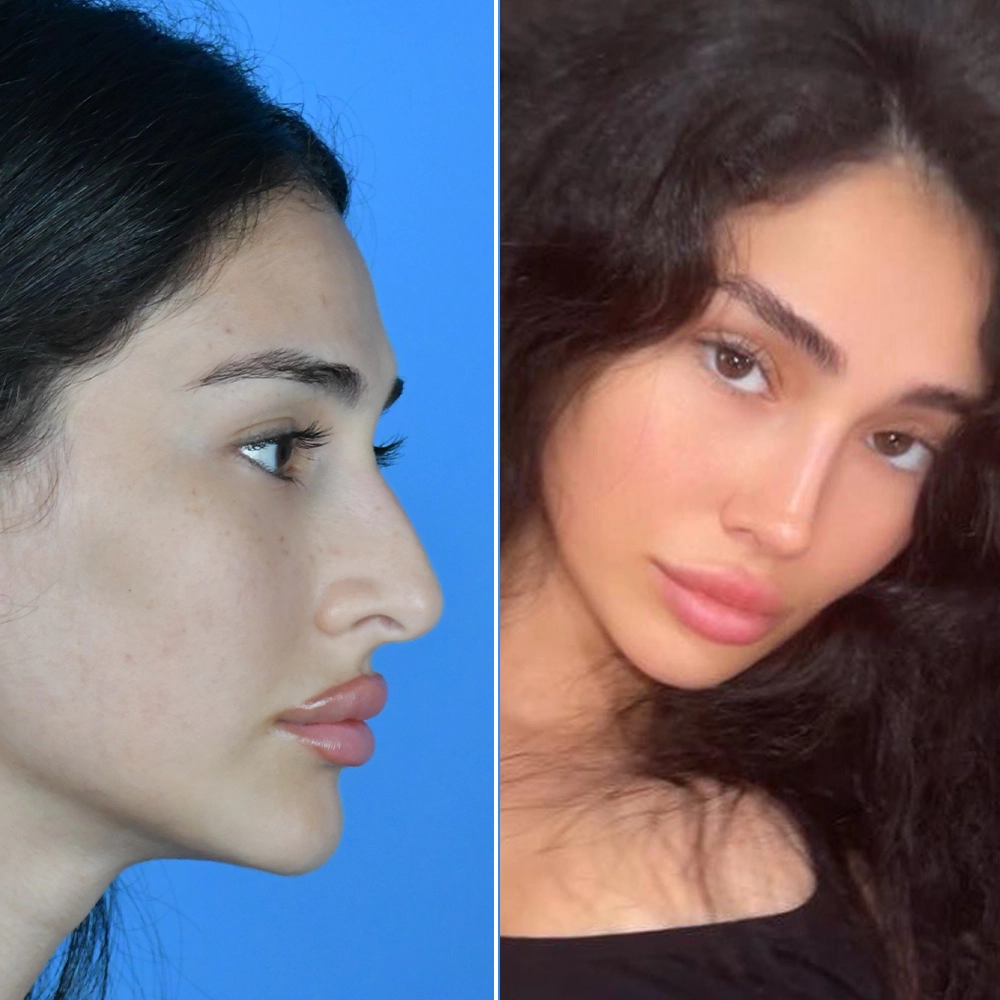 Before and after rhinoplasty result 1