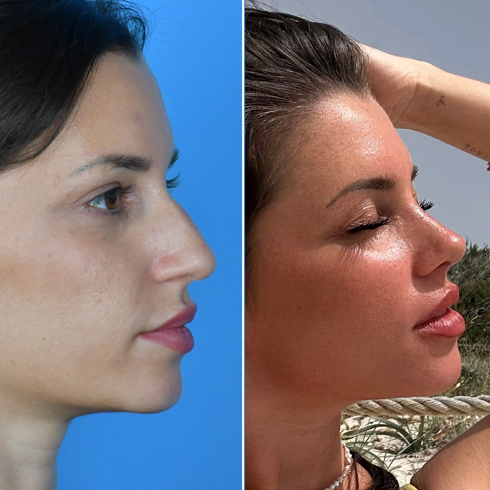 Before and after rhinoplasty result 2