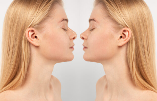 Rhinoplasty in Istanbul: Why Thousands of UK and European Patients Choose Turkey for Nose Surgery