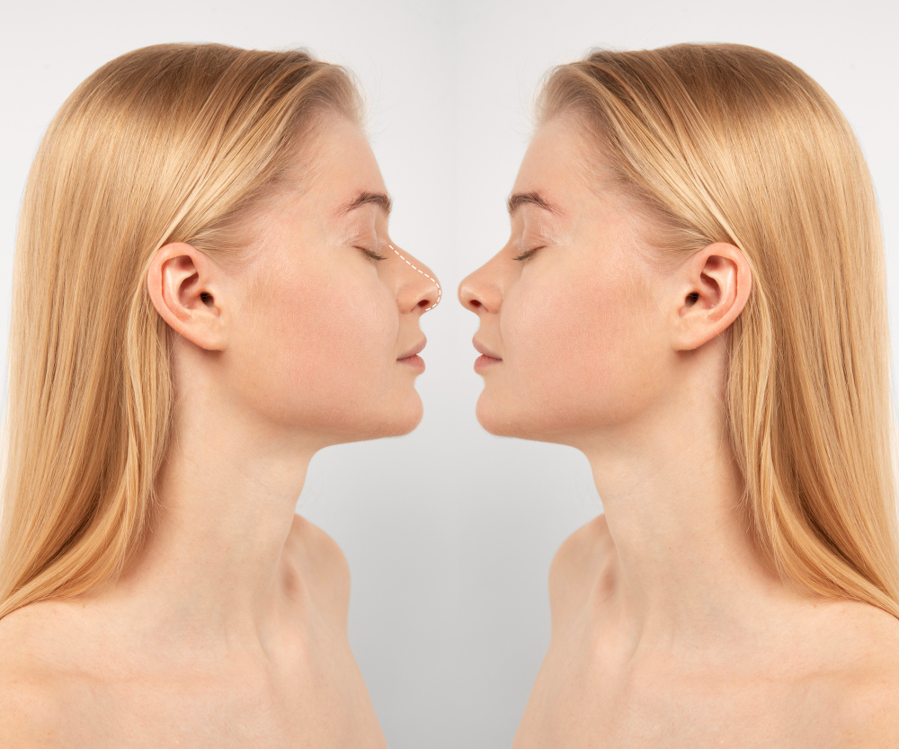 Rhinoplasty in Istanbul: Why Thousands of UK and European Patients Choose Turkey for Nose Surgery