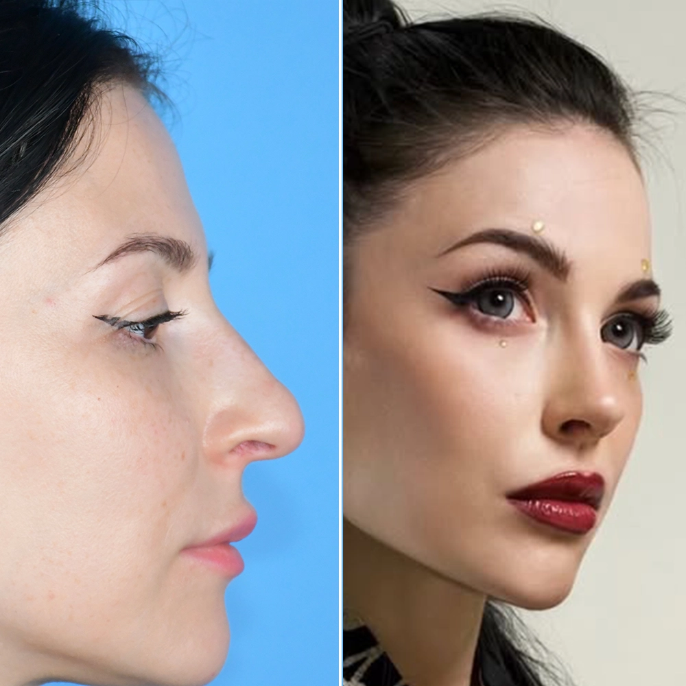 Before and after rhinoplasty — Charlotte B.