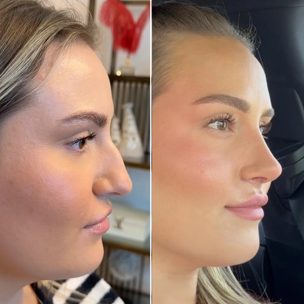 Before and after rhinoplasty — Lena V.