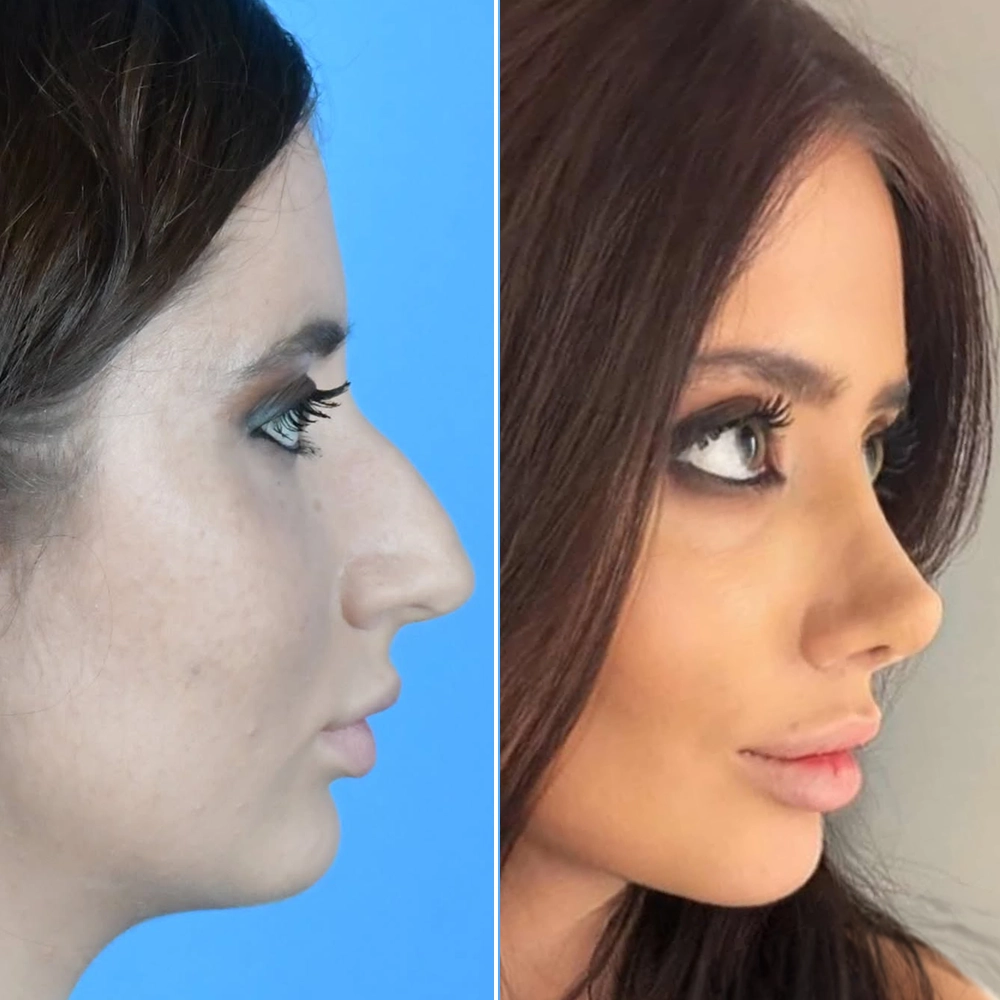 Before and after rhinoplasty result 2